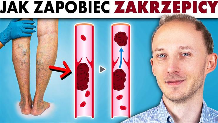 Zakrzepica zagraża zdrowiu i życiu - 17 rad, jak j... - Zakrzepica zagraża zdrowiu i życ...iknąć _ Dr Bartek Kulczyński BQ.jpg